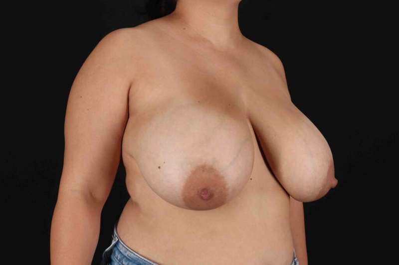 Breast Reduction with Lift Before & After Patient #994