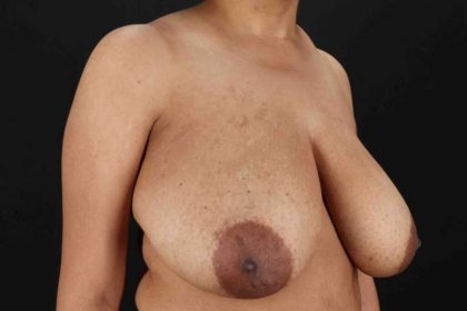 Breast Reduction with Lift Before & After Patient #1005