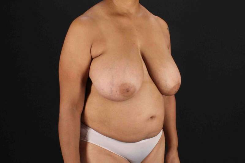 Breast Reconstruction Before & After Patient #1038