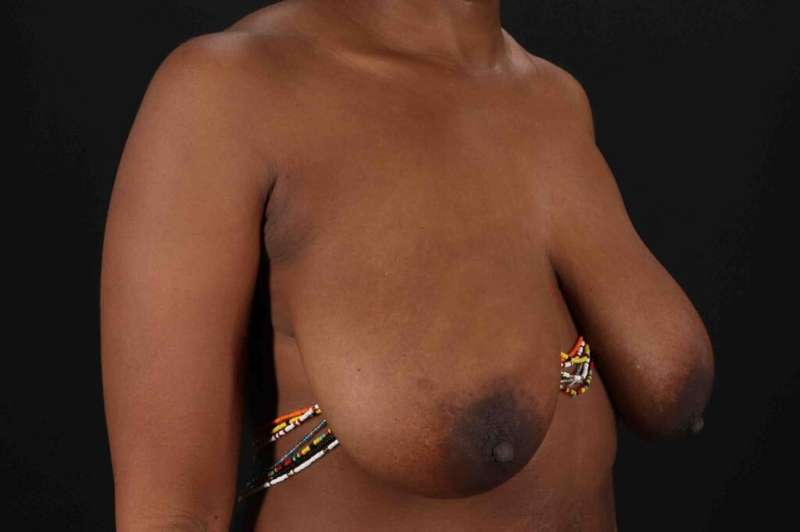 Breast Lift Before & After Patient #1049