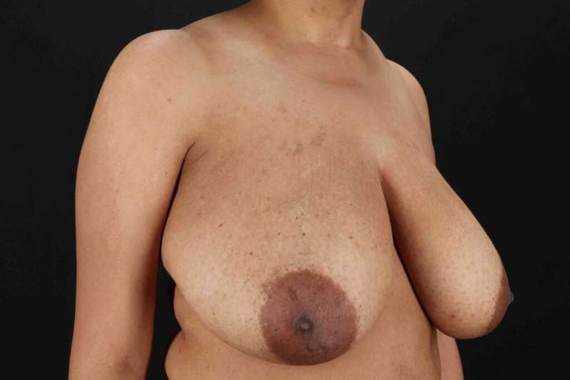 Breast Lift Before & After Patient #1159
