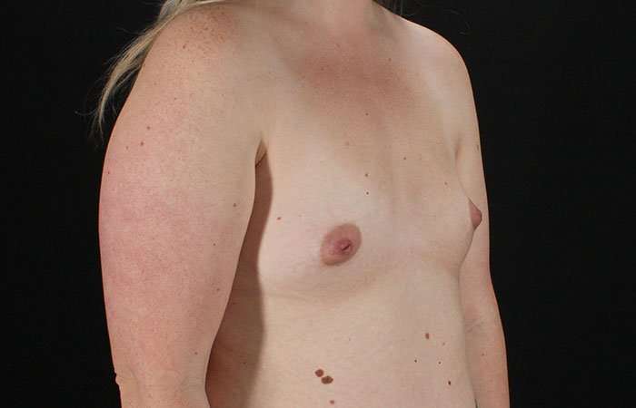 Breast Augmentation with Implants Before & After Patient #1258