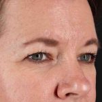 Brow Lift Before & After Patient #1566