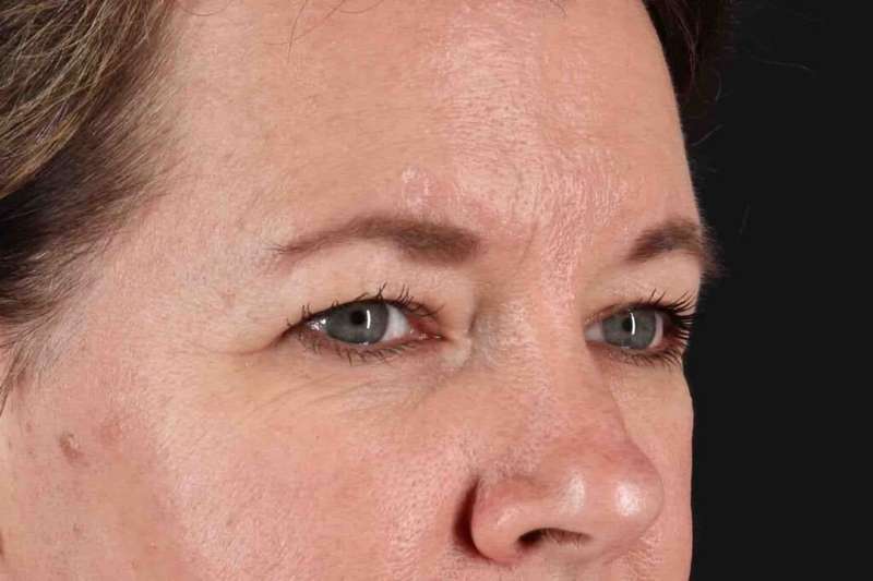 Brow Lift Before & After Patient #1566