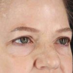 Brow Lift Before & After Patient #1577