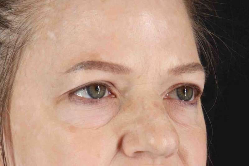 Brow Lift Before & After Patient #1577