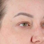 Brow Lift Before & After Patient #1588