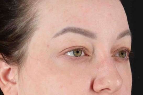 Brow Lift Before & After Patient #1588