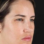 Brow Lift Before & After Patient #1599