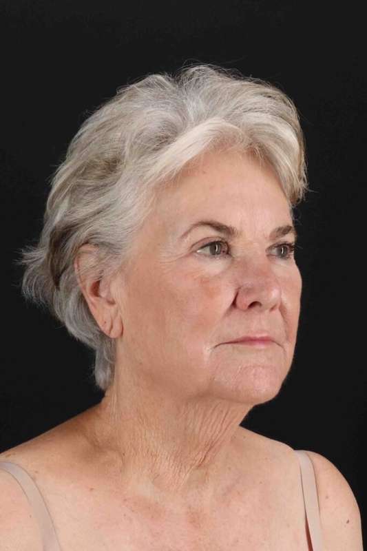 Neck Lift Before & After Patient #1676