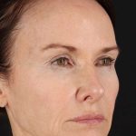 Neck Lift Before & After Patient #1698