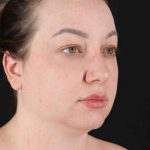 Neck Lift Before & After Patient #1720