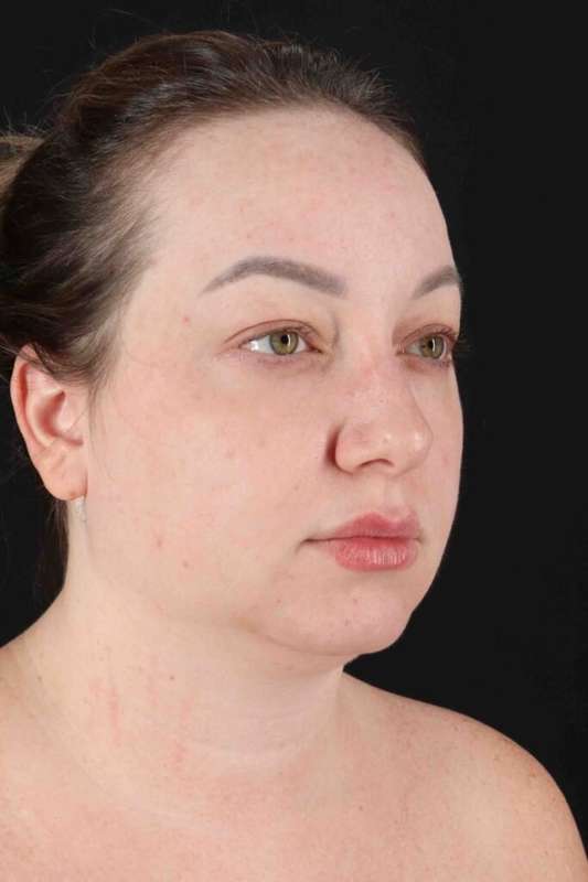 Neck Lift Before & After Patient #1720