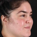 Neck Liposuction Before & After Patient #1775