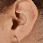 Earlobe Repair Before & After Patient #1791