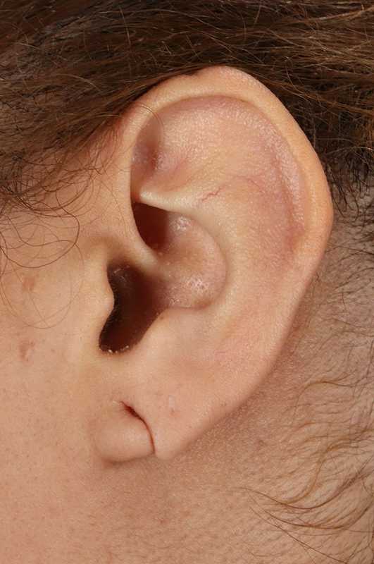 Earlobe Repair Before & After Patient #1791