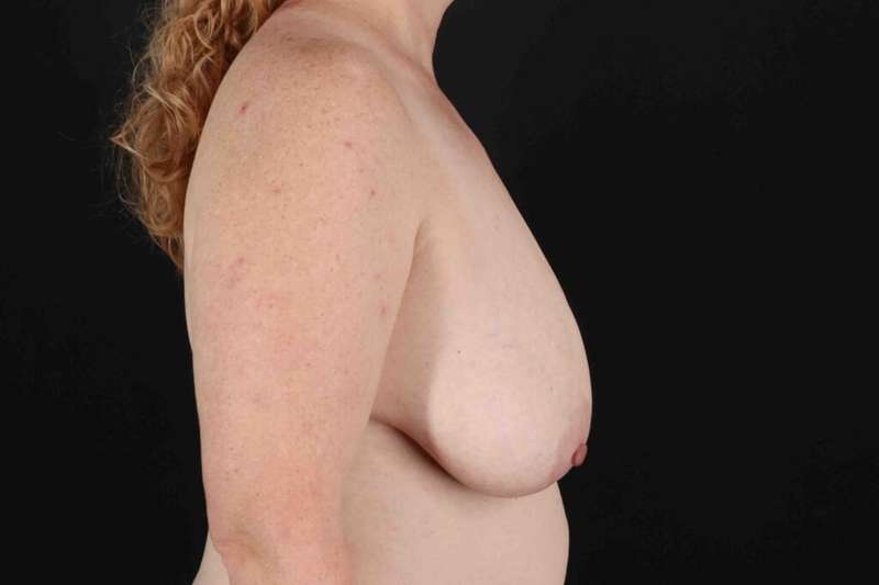 Breast Augmentation with Fat Transfer Before & After Patient #795