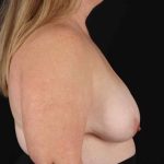 Breast Reduction with Lift Before & After Patient #894