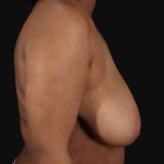 Breast Reduction with Lift Before & After Patient #905