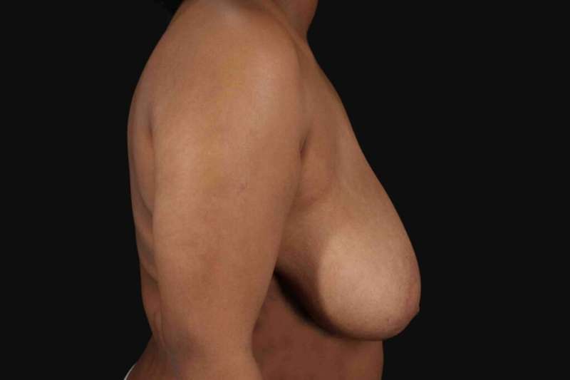 Breast Reduction with Lift Before & After Patient #905