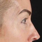 CO2 Laser Before & After Patient #2070