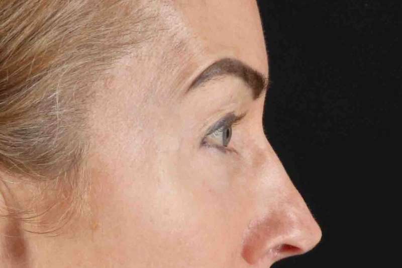 Laser Before & After Patient #2070