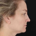 CO2 Laser Before & After Patient #2081