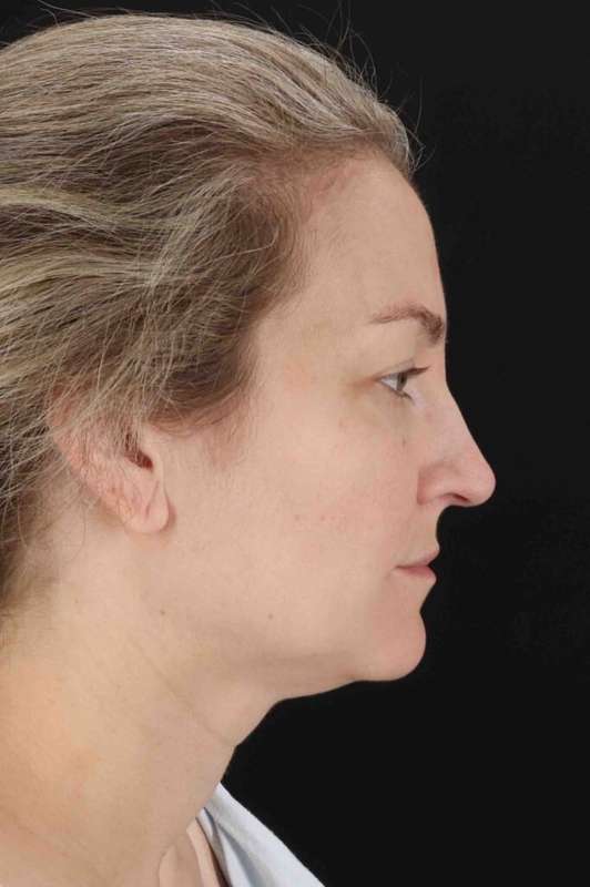 Laser Before & After Patient #2081