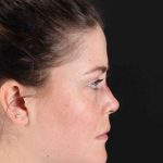 CO2 Laser Before & After Patient #2092
