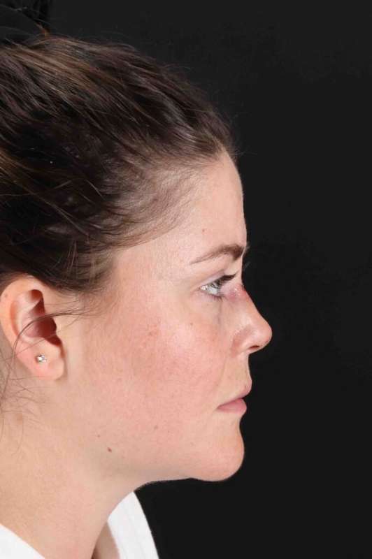 Laser Before & After Patient #2092