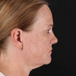 CO2 Laser Before & After Patient #2103
