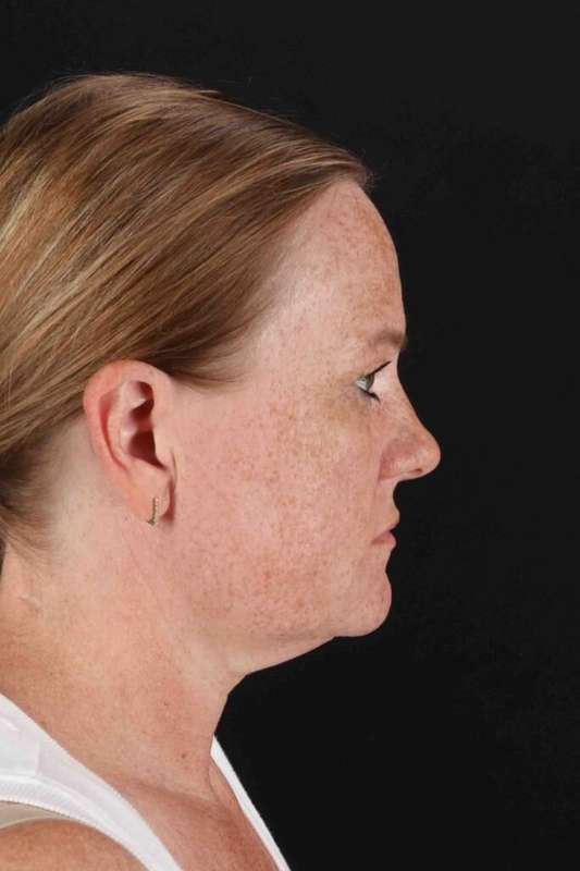 Laser Before & After Patient #2103