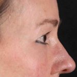 CO2 Laser Before & After Patient #2114