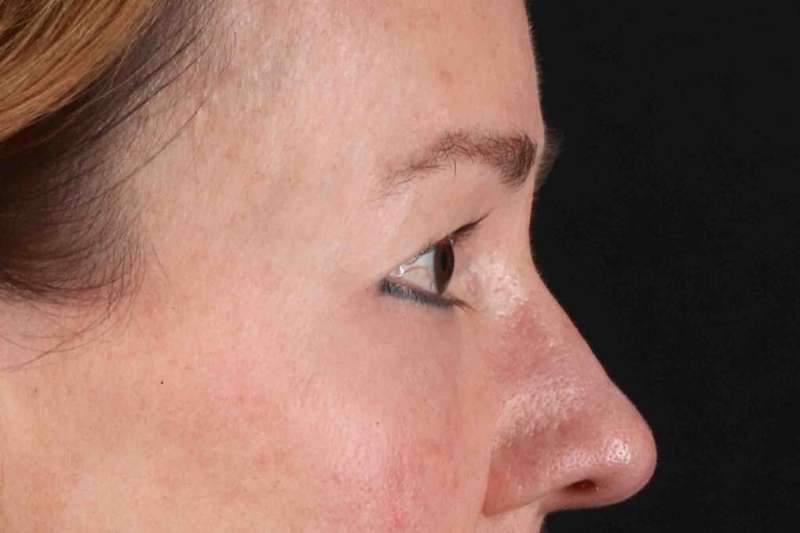 Laser Before & After Patient #2114