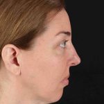 CO2 Laser Before & After Patient #2136