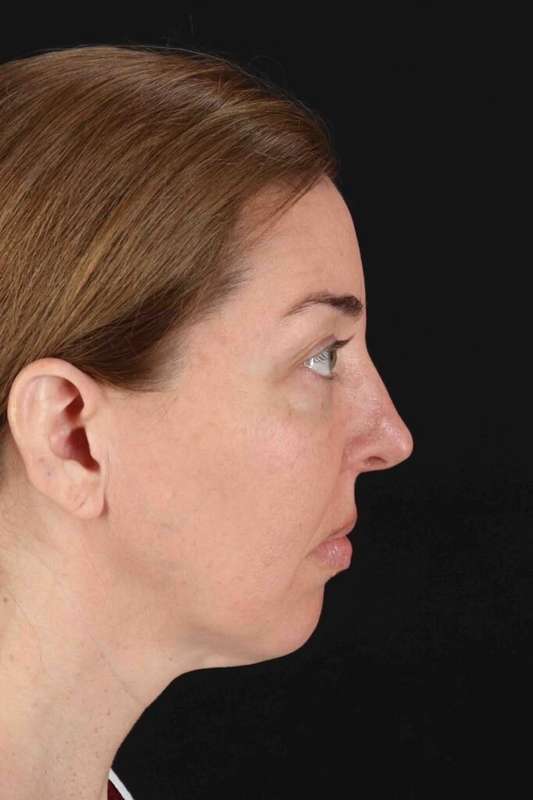 Laser Before & After Patient #2136