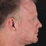CO2 Laser Before & After Patient #2158