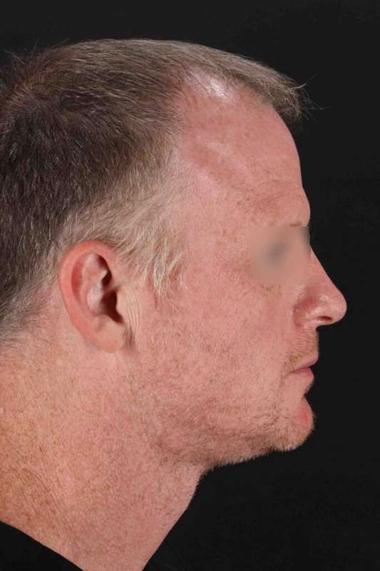 Laser Before & After Patient #2158