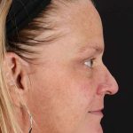 Chemical Peel Before & After Patient #2169