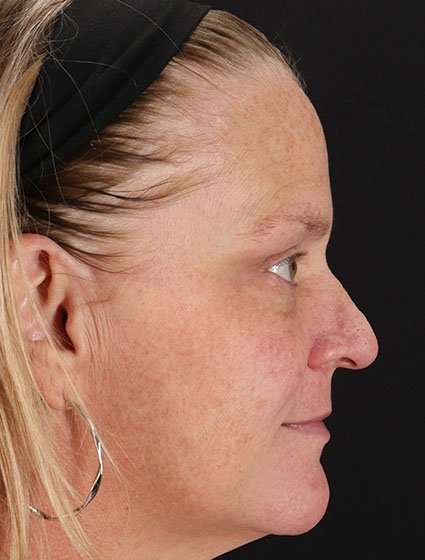 Chemical Peel Before & After Patient #2169