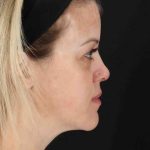 Chemical Peel Before & After Patient #2180