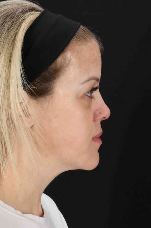 Chemical Peel Before & After Patient #2180