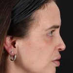 Chemical Peel Before & After Patient #2202