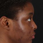 Chemical Peel Before & After Patient #2213