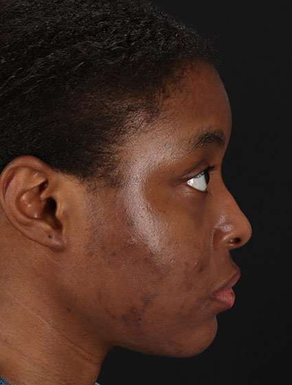 Chemical Peel Before & After Patient #2213