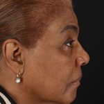 Chemical Peel Before & After Patient #2227