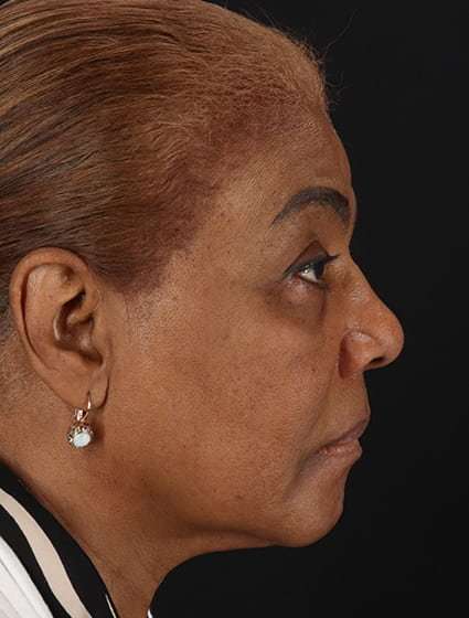 Chemical Peel Before & After Patient #2227