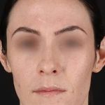 Cosmetic Injectables Before & After Patient #2236
