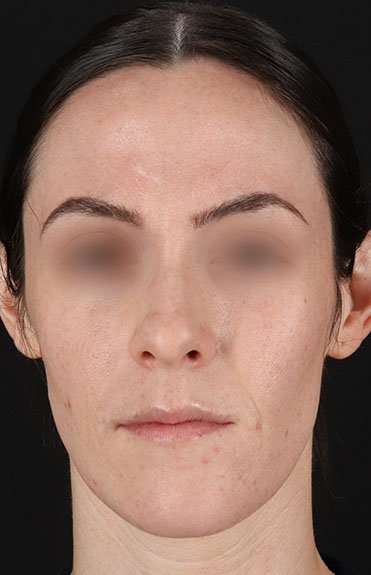 Cosmetic Injectables Before & After Patient #2236