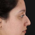 Cosmetic Injectables Before & After Patient #2253